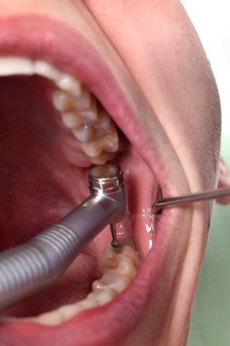 Diş hekimi tedavi işlemi yapar