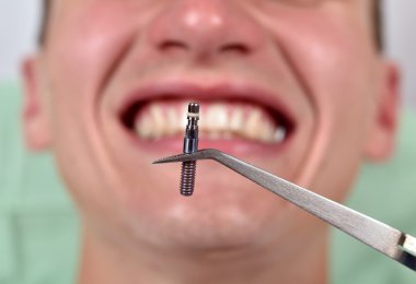 Cımbız diş implant