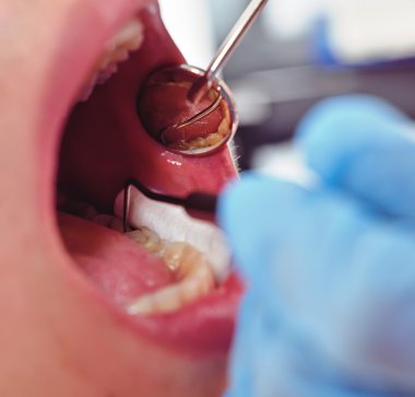 dentist examines patient's mouth