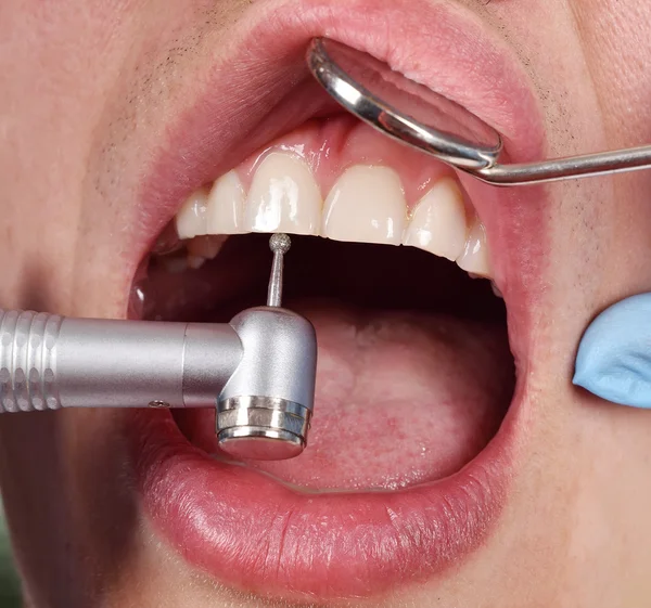 Za pomocą wiertła stomatologiczne dentysta — Zdjęcie stockowe