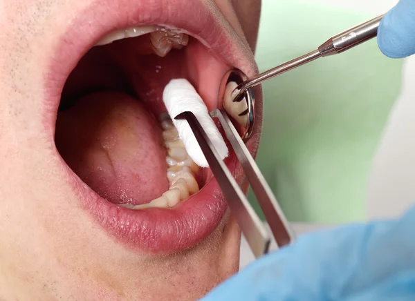 Insertos de dentista hisopo — Foto de Stock