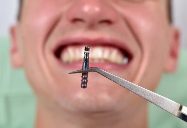 Dental implant in tweezers — Stock Photo, Image