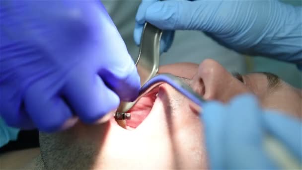 Procedimiento de implantación dental — Vídeos de Stock