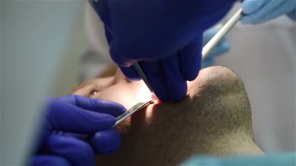 Zubní chirurgie — Stock video