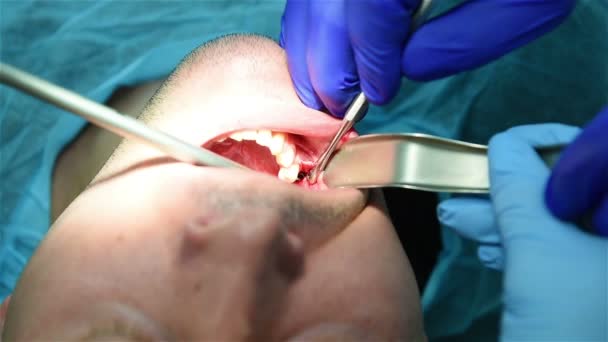 Kacau ke dalam implan gigi rahang — Stok Video