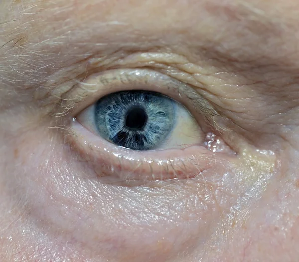 Iridocorneal endotel Sendromu-göz sorunu tetkikleri