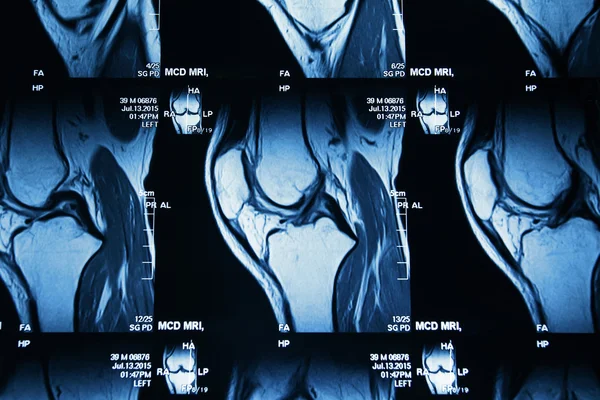 Μαγνητική τομογραφία εικόνα του κοινού ποδιού γόνατο — Φωτογραφία Αρχείου