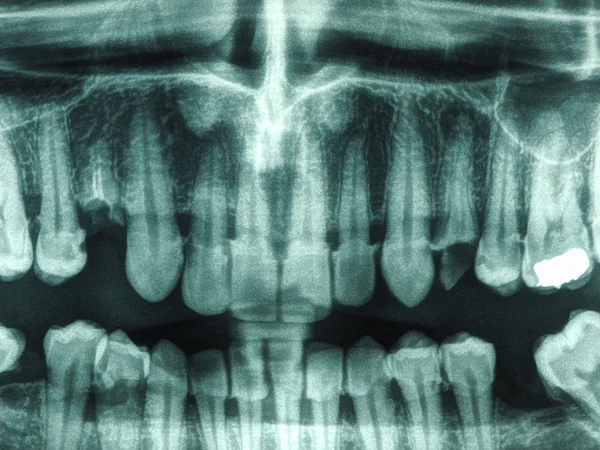 人类牙齿 x 射线 — 图库照片