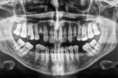 İnsan dişleri xray siyah beyaz