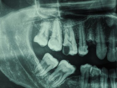 İnsan dişleri xray
