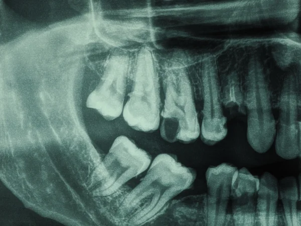 Xray людини зубів — стокове фото