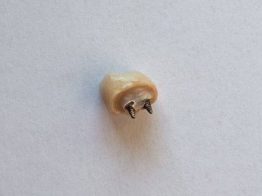 Metal direkli, çekirdek dolgusu ve tacı olan kırık diş.