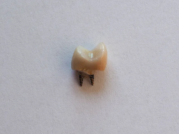Zlomený Zub Kovovou Tyčí Jádrovou Výplní Korunou — Stock fotografie