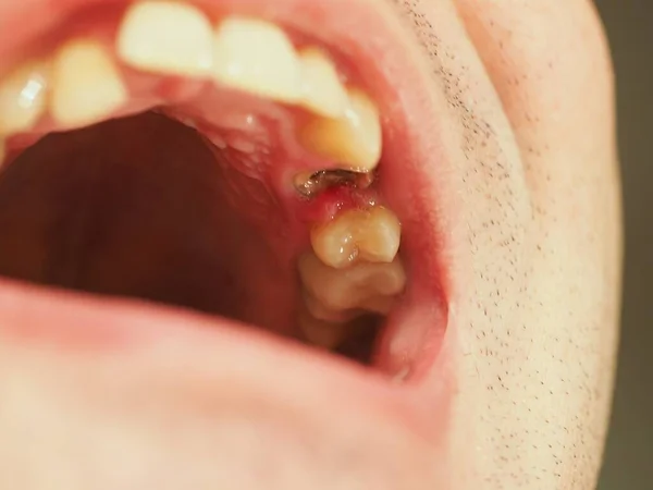 Gebrochener Zahn Bereit Nach Wurzelkanal Mit Pfahl Und Kern Füllen — Stockfoto