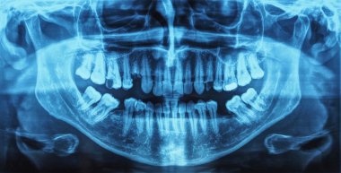 tıbbi xray