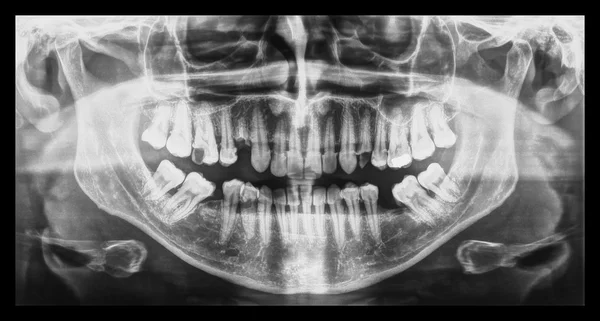 Medische röntgenstraal — Stockfoto