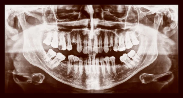 복고풍 봐 의료 Xray — 스톡 사진