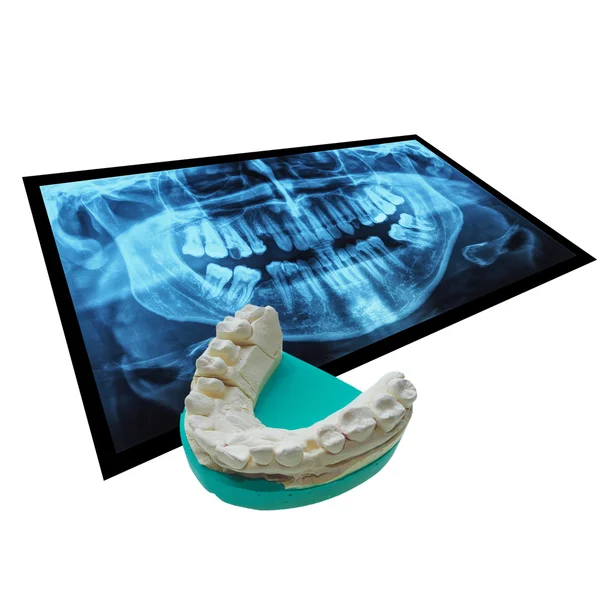 Xray of teeth with positive teeth cast — Stock Photo, Image