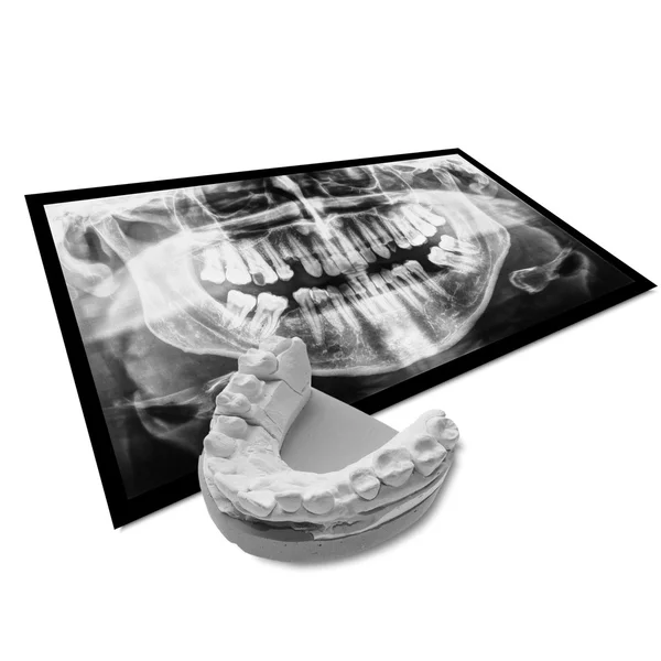 Xray of teeth with positive teeth cast Stock Photo by ©claudiodivizia