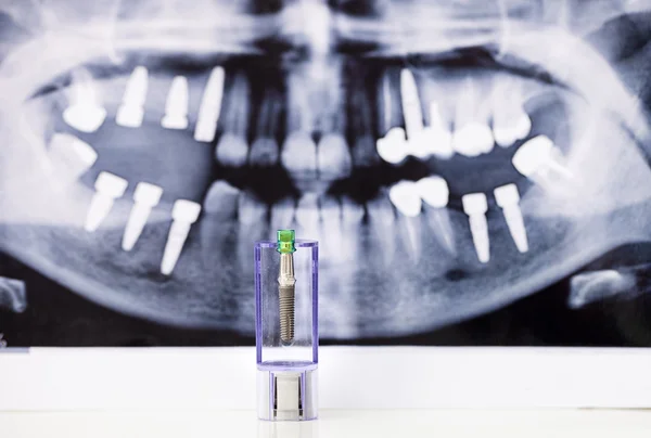 Dental Implant and tooth radiography — Stock Photo, Image