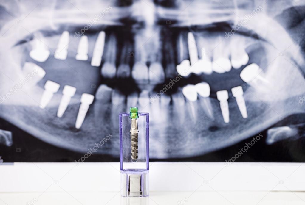 Dental Implant and tooth radiography — Stock Photo © photobac 92008336