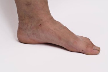 Bacağının altındaki büyüyen damarlar kronik venöz yetersizliği gösteriyor. Bilek bölgesindeki belirgin bükülmüş damarlar ve pigmentasyon değişiklikleri venöz reflüyü gösteriyor. Bacaklardaki varis damarları. Bacağında şişlik var.