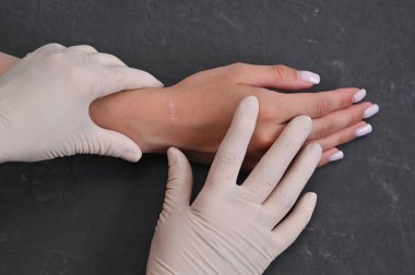 Higroma alınıyor. Denetleme sırasında eldiven takan bir tıp uzmanı tarafından elle muayene edildi. Hasta bileğinde cerrahi yara izi, iyileşme süreci, tedavi değerlendirmesi ve bakımı