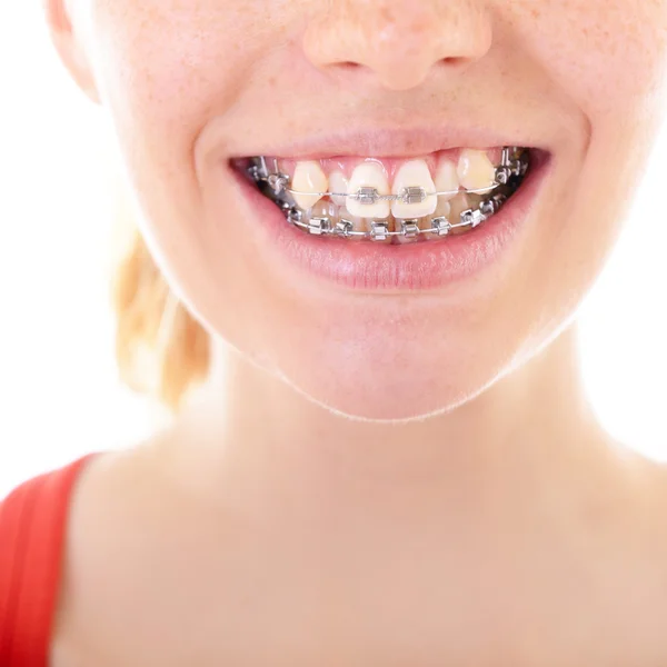 Zęby z nawiasami klamrowymi zbliżenie — Zdjęcie stockowe