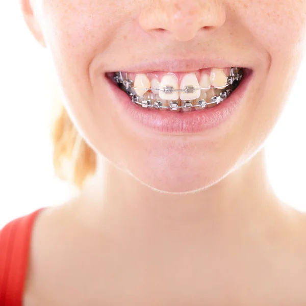 Teeth with braces closeup Royalty Free Stock Photos