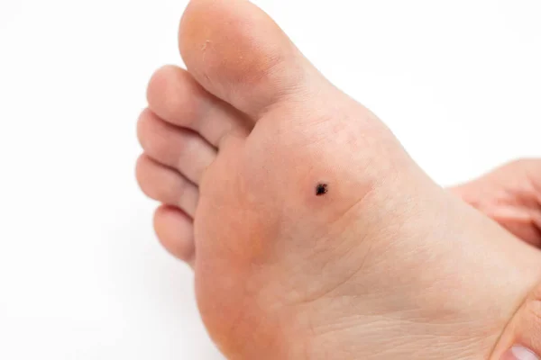 Warte Auf Die Fußsohle Entfernung Einer Plantarwarze — Stockfoto