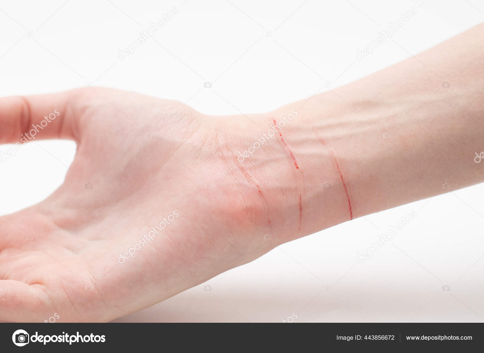 Skin Hand Cat Scratch Self Harm Hand — Stock Photo © dmitryi