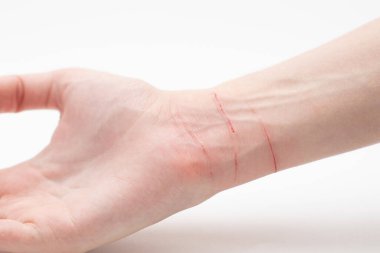 Kedi tırmalaması üstüne deri. Kendine zarar veriyor..