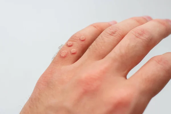 Палець Бородавками Вірусні Бородавки Руці — стокове фото