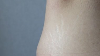 Kalçalarında çatlaklar gösteren bir kadın.