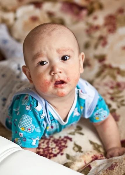 Baby with eczema on face Stock Picture