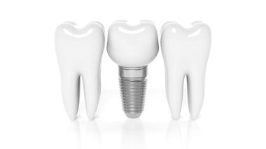 Satır ile beyaz arka plan üzerinde izole implant diş diş