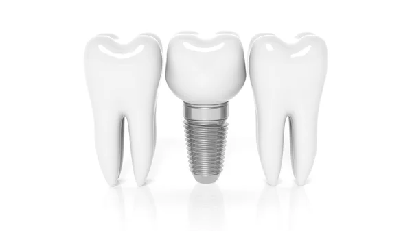 Fila de dientes con implante dental aislado sobre fondo blanco — Foto de Stock