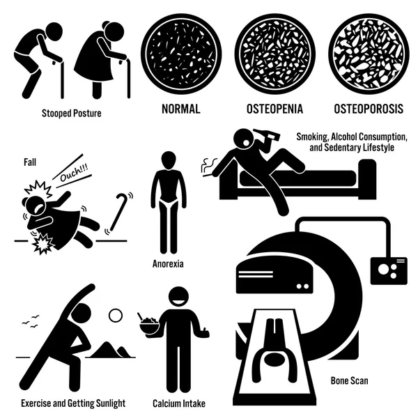 Ostéoporose Vieil Homme Femme Symptômes Facteurs de risque Prévention Diagnostic Bâton Figure Pictogramme Icônes — Image vectorielle