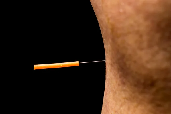 Acupuncture treatment on leg — Stock Photo, Image