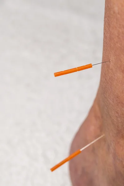Acupuncture treatment on leg — Stock Photo, Image