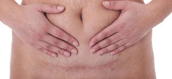 Scar after a Caesarean section, Bikini line — Stock Photo, Image