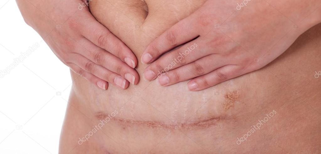 Scar after a Caesarean section, Bikini line