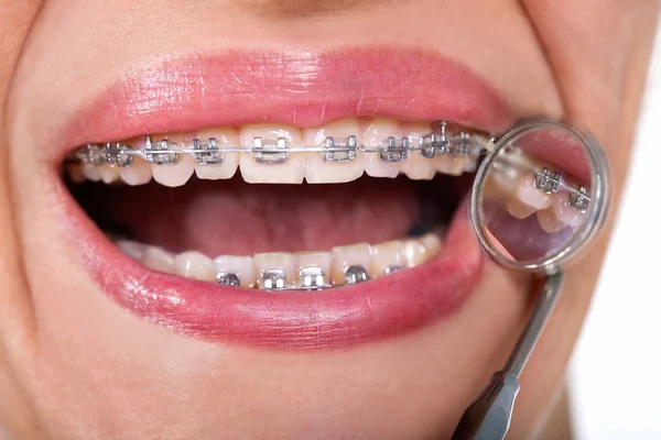 Paciente femenina mostrando sus frenos linguales en el espejo dental — Foto de Stock