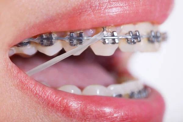 Closeup seramik ve elastik kauçuk Ba ile dişlerde Metal diş telleri