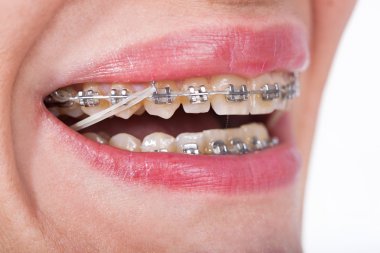 Closeup seramik ve elastik kauçuk Ba ile dişlerde Metal diş telleri