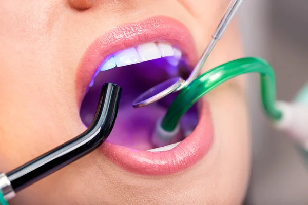 Hermosa sonrisa de mujer, concepto de clínica de salud dental — Foto de Stock