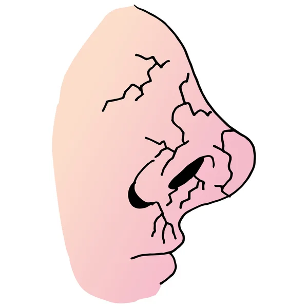 Сухой нос, который треснул и больно — стоковый вектор