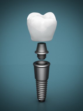 Diş implantları