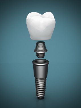 Dental implants clipart