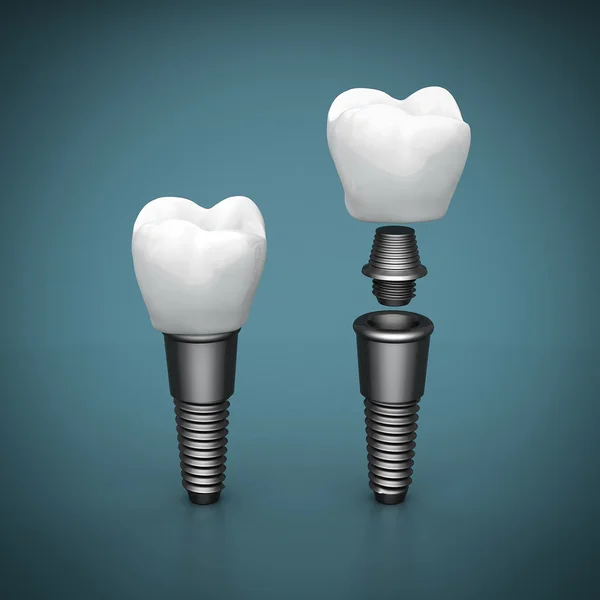 Fogászati implantátumok Stock Kép